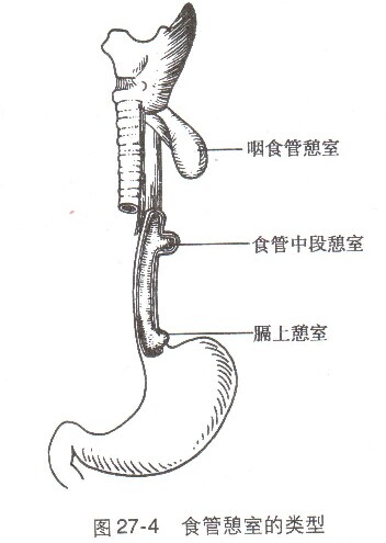 咽食管憩室