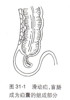 疾病搜索 外科 腹外疝      嵌顿性疝和绞窄性疝实际上是一个病理过程