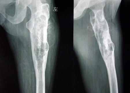 常见的恶性骨肿瘤之一,好发于四肢长骨与骨盆,也可见于椎骨,骶骨,锁骨