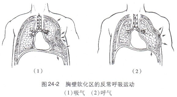 肋骨骨折解剖图图片