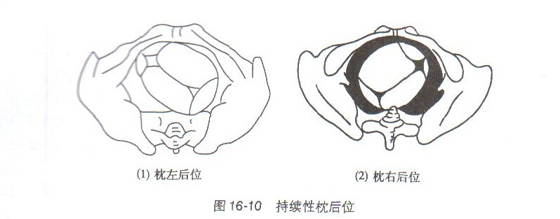 枕部在下降过程中