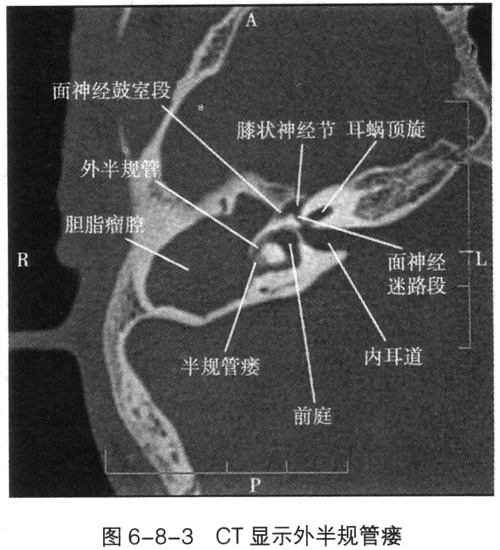 内听道解剖图片