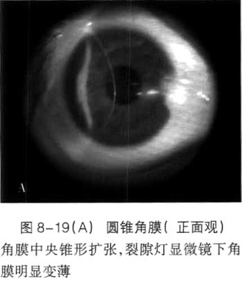 圆锥角膜的临床表现